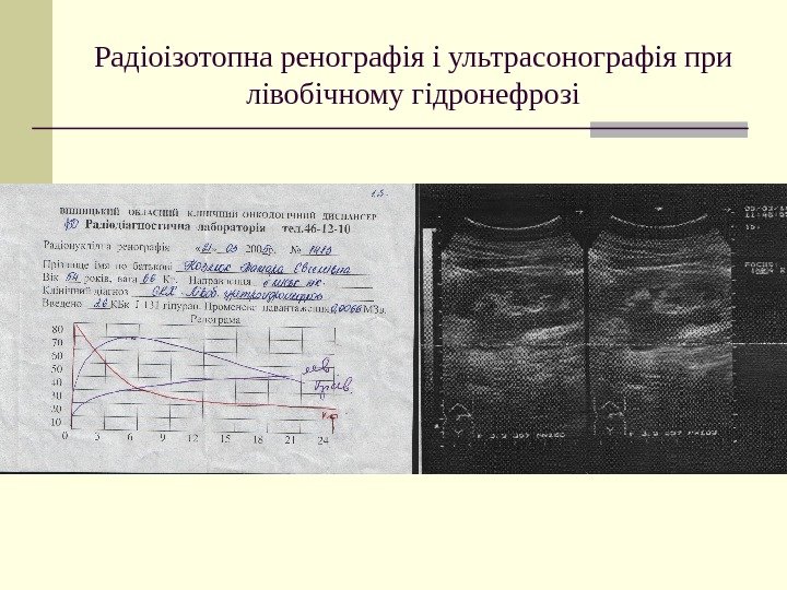   Радіоізотопна ренографія і ультрасонографія при лівобічному гідронефрозі 